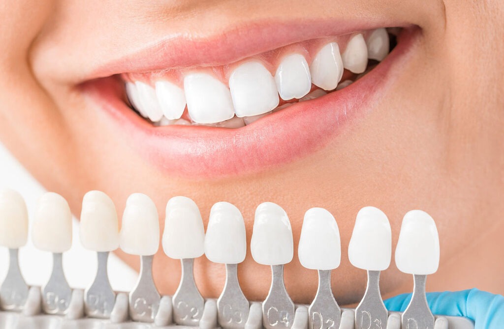 Metal Destekli Porselen Kaplama