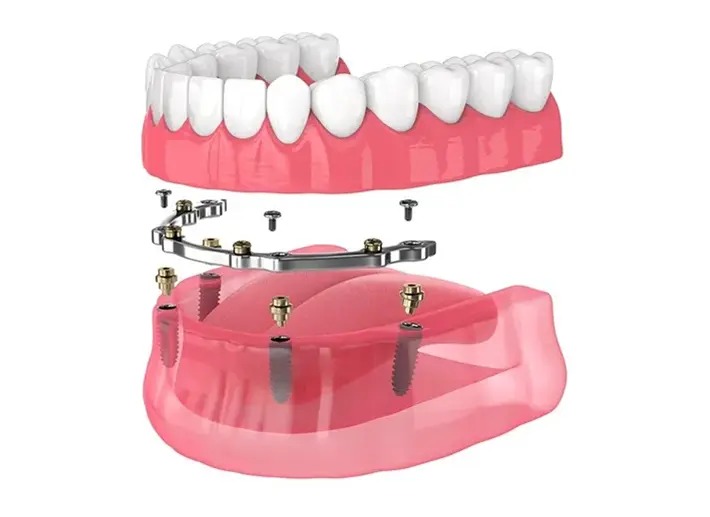 Multi Sistem Barlı İmplant Üstü Protez