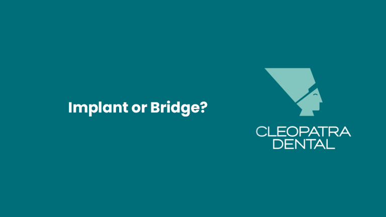 Implant or Bridge?