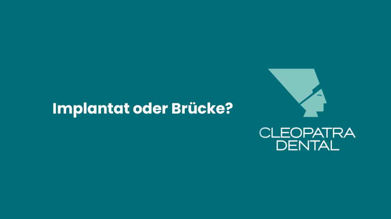 Implantat oder Brücke?