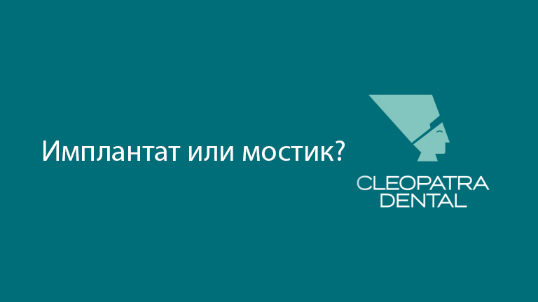 Имплантат или мостик?